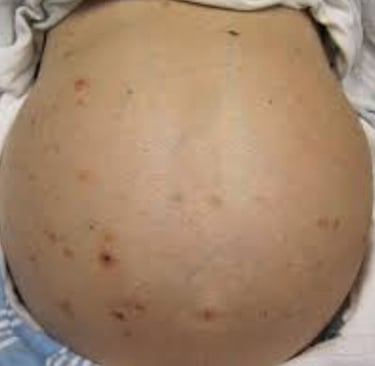Abdominal Distension