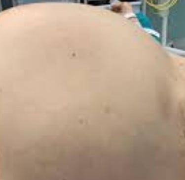 Abdominal Distension
