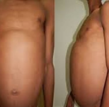 Abdominal Distension