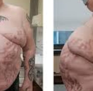 Ascites