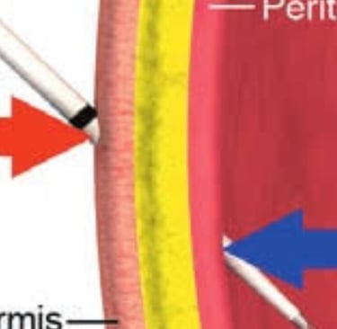 Abdominal Paracentesis Diagnostic and Therapeuti