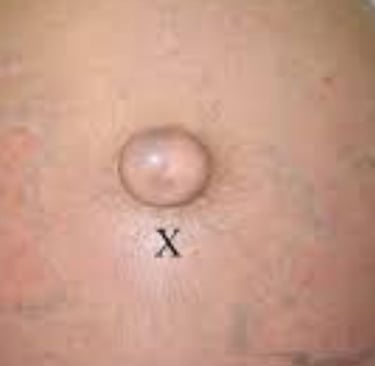 Abdominal Paracentesis Diagnostic and Therapeutic complementary issues (2)
