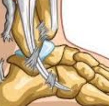 Achilles Tendon Injury