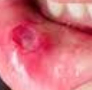 Behçet's Disease : A Comprehensive Overview and Treatments