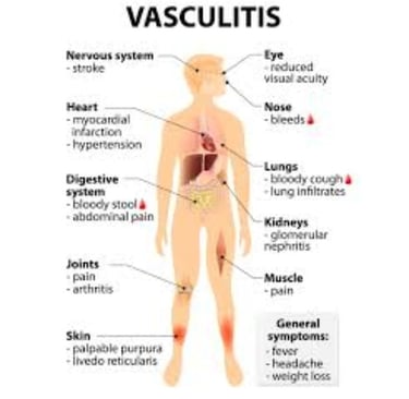 vasculitis