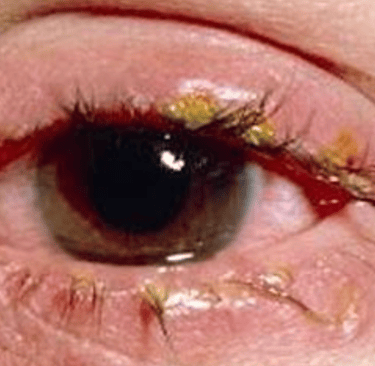 bepharitis