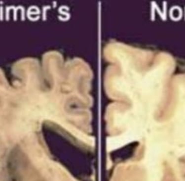 Alzheimer's