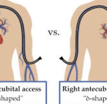 Cardiac Catheterization Why Every Case Is Followed by a Stent (3)