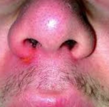 nose inflammation