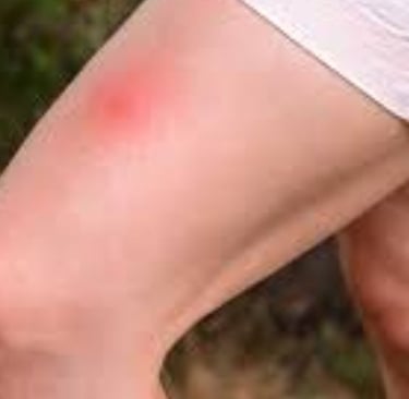 Complete Guide to Bee Stings  Treatment option , 
