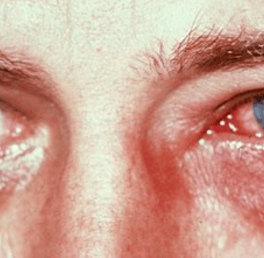 conjunctivitis