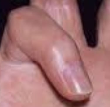🤲 Trigger Finger & the Role of Voluntary Fasting: A Natural Healing Approach