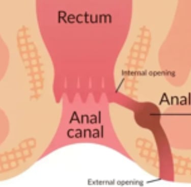 🍯Anal Fissures and Fistulas try honey first
