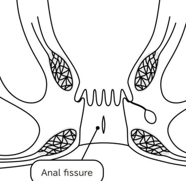 🍯Anal Fissures and Fistulas try honey first