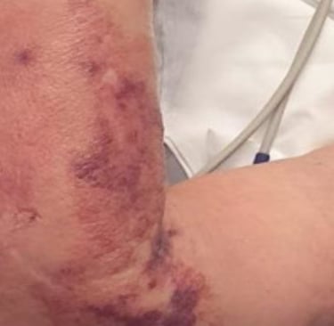 🦠 Flesh-Eating Disease (Necrotizing Fasciitis)