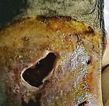 🦠 Flesh-Eating Disease (Necrotizing Fasciitis)