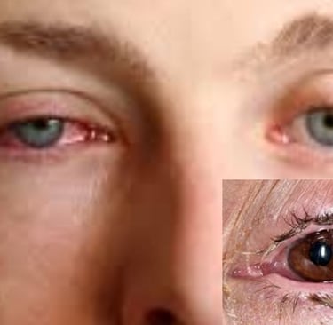 Conjunctivitis