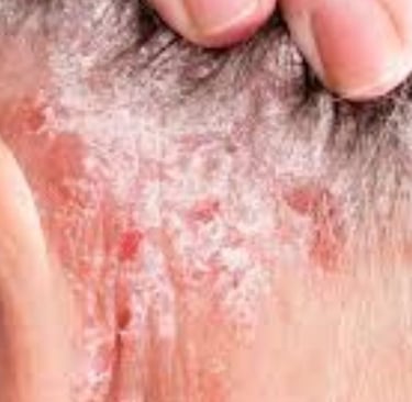 🧬 How Fasting Calms the Immune System in Psoriasis and Eczema