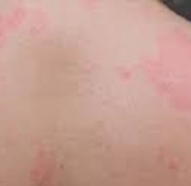 🧬 How Fasting Calms the Immune System in Psoriasis and Eczema