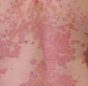 🧬 How Fasting Calms the Immune System in Psoriasis and Eczema