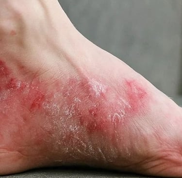 🧬 How Fasting Calms the Immune System in Psoriasis and Eczema