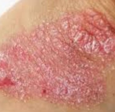 🧬 How Fasting Calms the Immune System in Psoriasis and Eczema