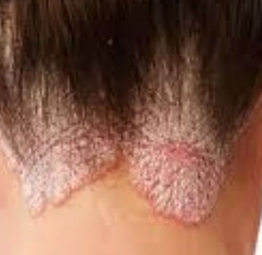 🧬 How Fasting Calms the Immune System in Psoriasis and Eczema