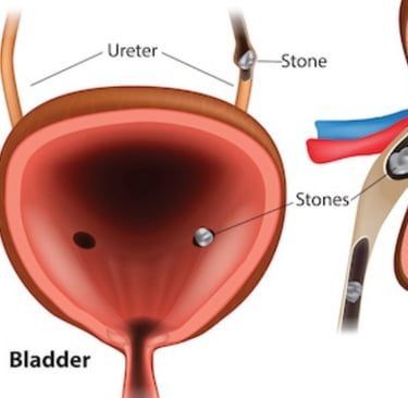 💧🧊🌙Fasting and Kidney Stones : What You Need to Know