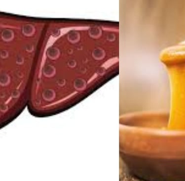 Esophageal Varices honey manouka and fasting