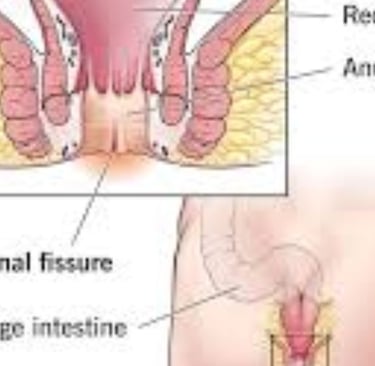 FAQs Natural Remedies for Anal Fissures and Fistulas Start with Honey and Fasting