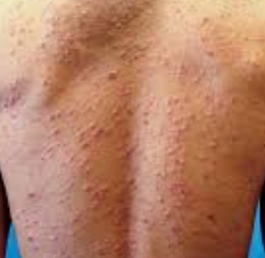 Fasting For Skin Allergies Itching & Pruritus