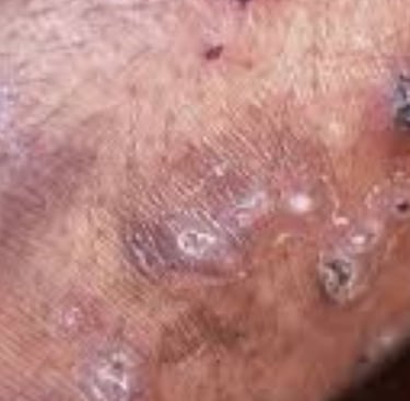 Fasting for Skin Allergies, Itching, and Pruritus