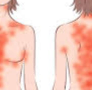 Fasting For Skin Allergies Itching & Pruritus