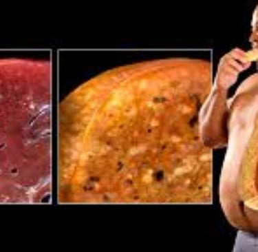 fatty liver more in obese patient