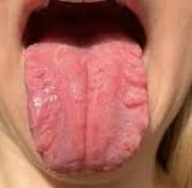 FISSURED TONGUE