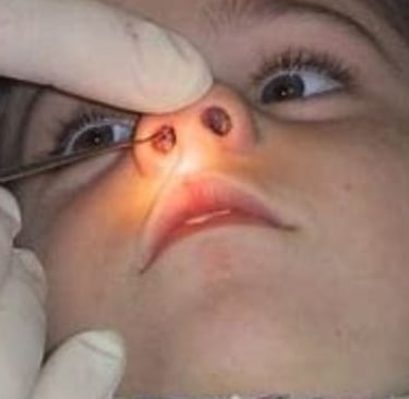 nasal f b removal