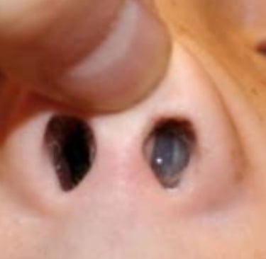 how to remove foreign body from the nose of a child