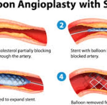 ballon angioplasty with stent