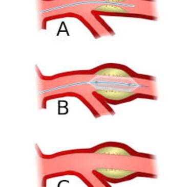 angioplasty