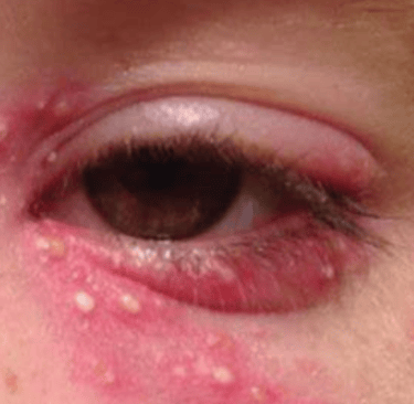 herpes simplex