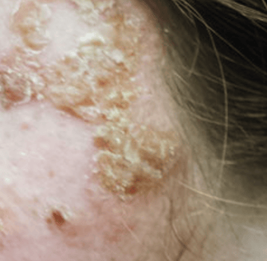 Herpes Simplex, Genitalia & Ophthalmicus herpes is a viral infection that can cause sores on the ge