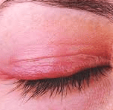 Watery eyes, dryness, itching, and burning in the eyes during fall and winter  Watery eyes, dryness,