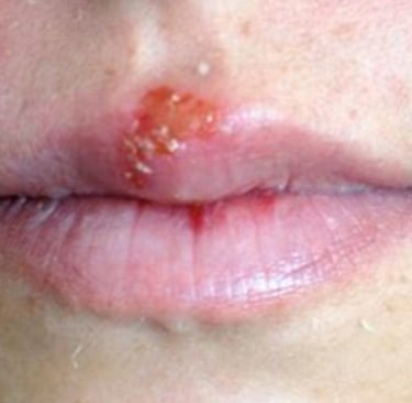 🧪 Fasting & Honey: A Natural Approach to Herpes Management