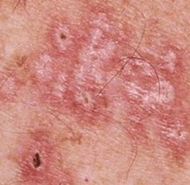 herpes genitalia