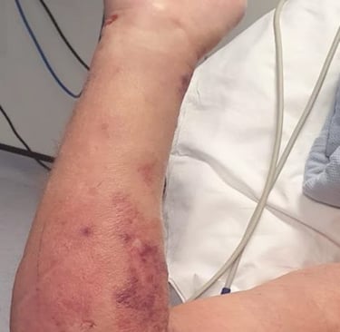 🦠 Flesh-Eating Disease (Necrotizing Fasciitis)