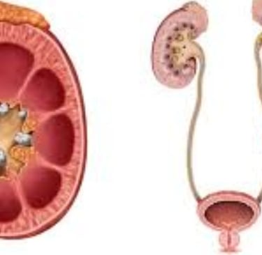Causes and Prevention of Kidney Stones, Impacted  
