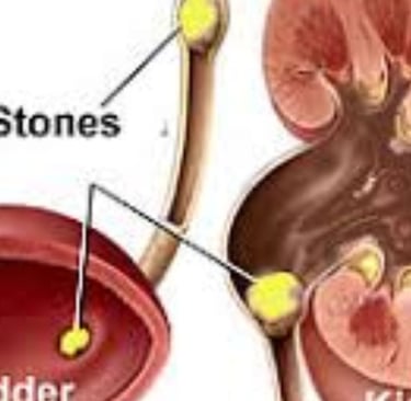 Kidney stonesimpacted ureter stonesbladder stones