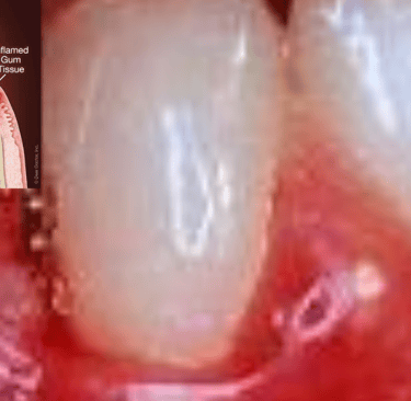 gums disease 