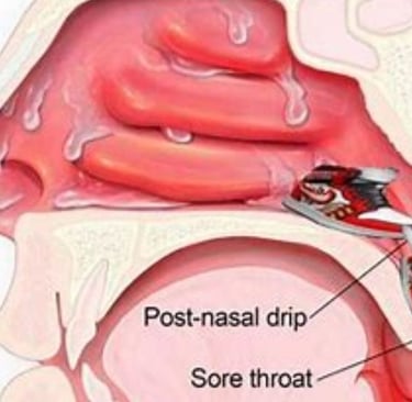   drop in the nose and throat
