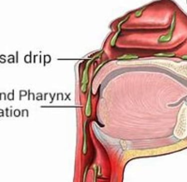 a diagram of the anatomy of the throat of the head and neck oost nasal discharge